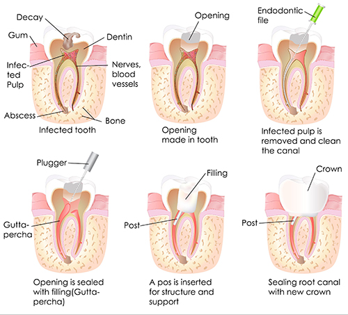 root canal in Manteno