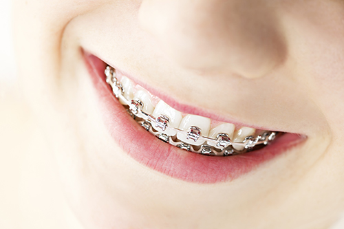 dental braces in Manteno