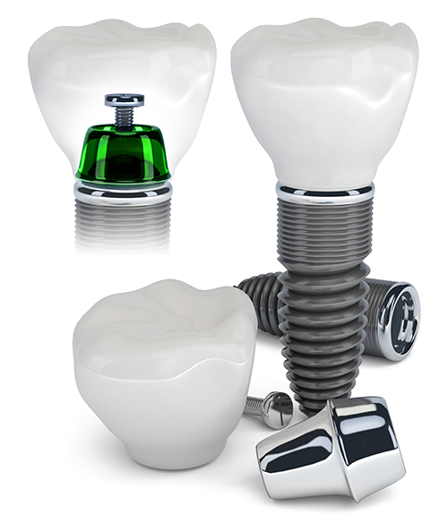 Manteno dental implants