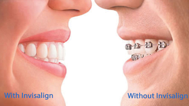 60950 invisalign